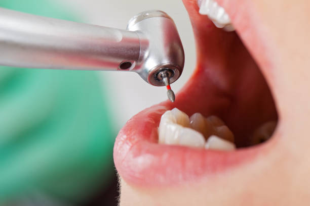 Best Emergency Wisdom Teeth Removal in Dayton, TN